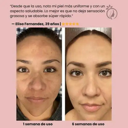 ClaraPiel® – Tu aliado contra las manchas oscuras